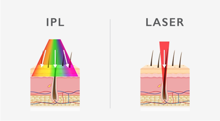 What Is The Difference Between Laser And Ipl Intense Pulsed Light For Hair Removal Belfast Laser Skin Therapy